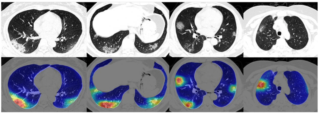 Abbildung 3: Bildsegmentierung von Lungen CT-Scans