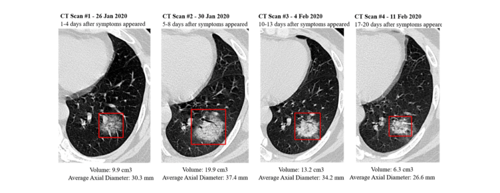 Abbildung 4: COVID-19 Tracking mittels CT-Scans